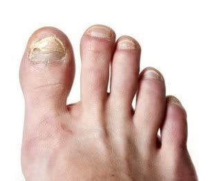 New York, Health & Beauty Items, USD 24,  Zeta Clear Nail Fungus Treatment: What You Should Know Before Trying It