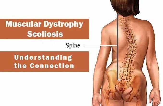 Gurgaon, Businesses For Sale, Muscular Dystrophy Treatment In Gurgaon : Effective Physiotherapy Treatment To Patients