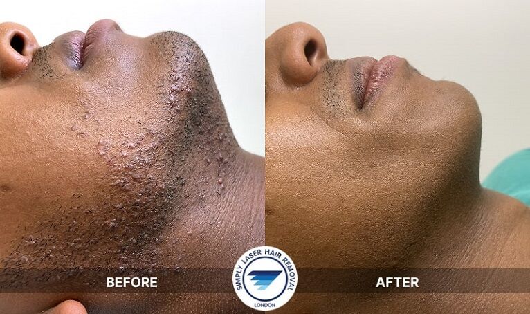 London, Business, Simply Laser Hair Removal