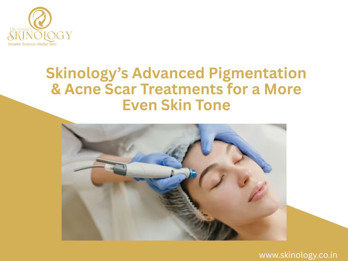 Indore, Health, Skinology&rsquo;s Advanced Pigmentation & Acne Scar Treatments For A More Even Skin Tone