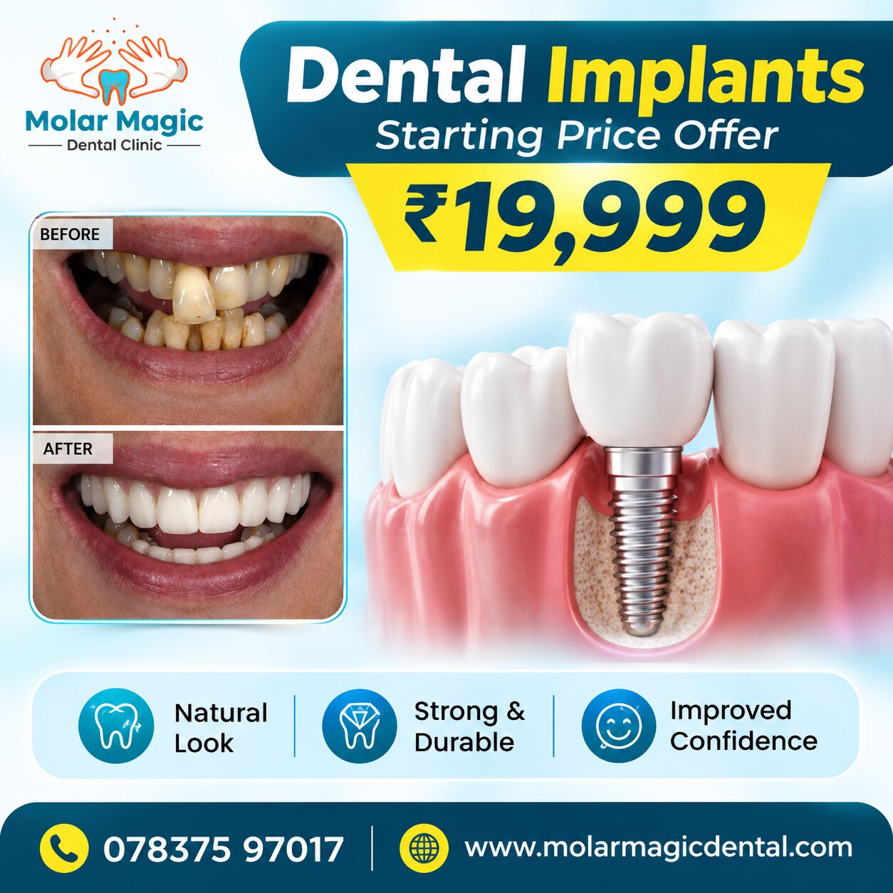 Chandigarh, Dental, Affordable Dental Implants In Chandigarh Book Now