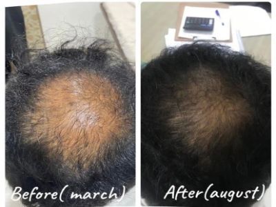 Kolkata, General, The Aesthetic House &ndash; Personalized Hair Loss Treatment In Rajarhat
