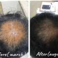 The Aesthetic House &ndash; Personalized Hair Loss Treatment In Rajarhat