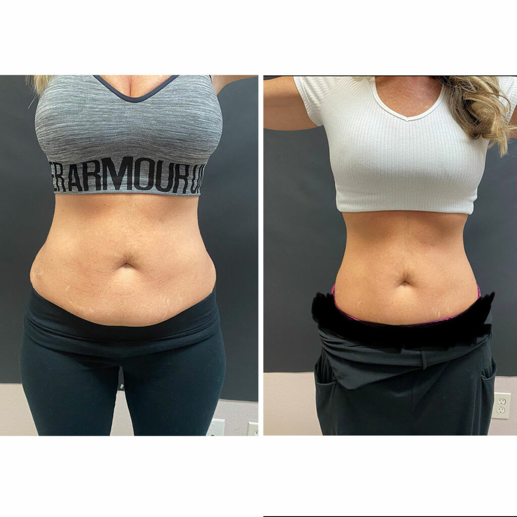 Mississauga, Beautician, Body Fat Treatment Near Me &ndash; Advanced Body Contouring & Fat Reduction