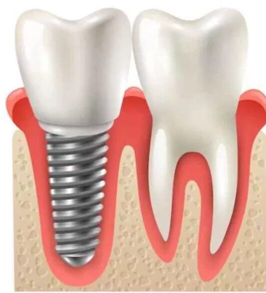 Ajman, Dental, Restore Your Smile With Dental Implants In Ajman
