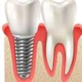 Restore Your Smile With Dental Implants In Ajman