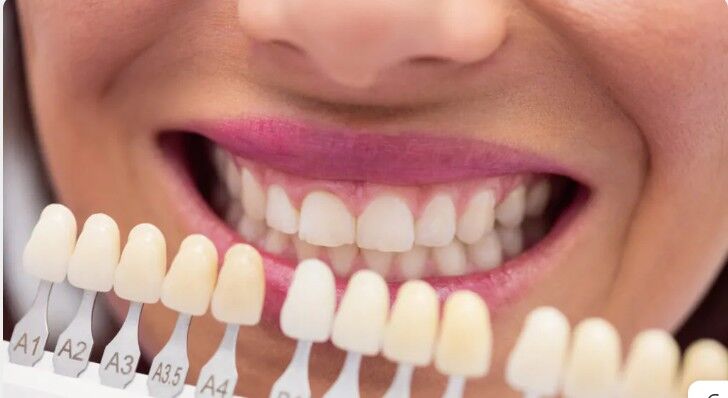 Ajman, Dental, Transform Your Smile With Veneers In Ajman