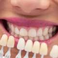 Transform Your Smile With Veneers In Ajman