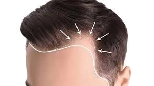 New Delhi, Health, No Shave, No Stress &mdash; Unshaven Hair Transplant In Delhi Is Here!