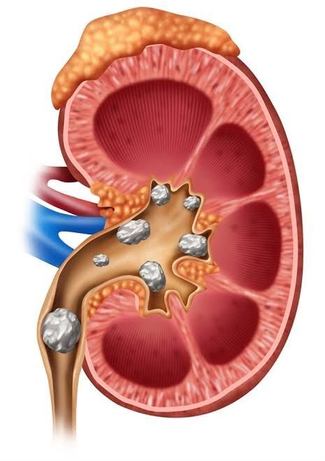 New Delhi, Health, Laser Kidney Stone Treatment In Delhi