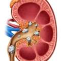 Laser Kidney Stone Treatment In Delhi