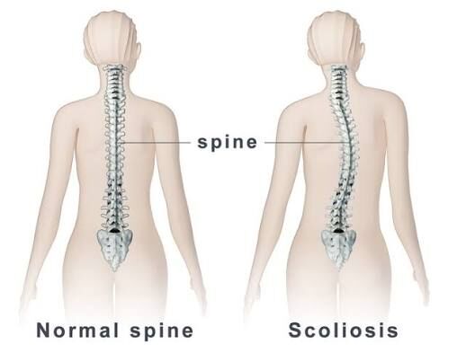 Gurgaon, Businesses For Sale, Scoliosis Treatment In Gurgaon For Improved Flexibility And Strength