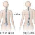 Scoliosis Treatment In Gurgaon For Improved Flexibility And Strength