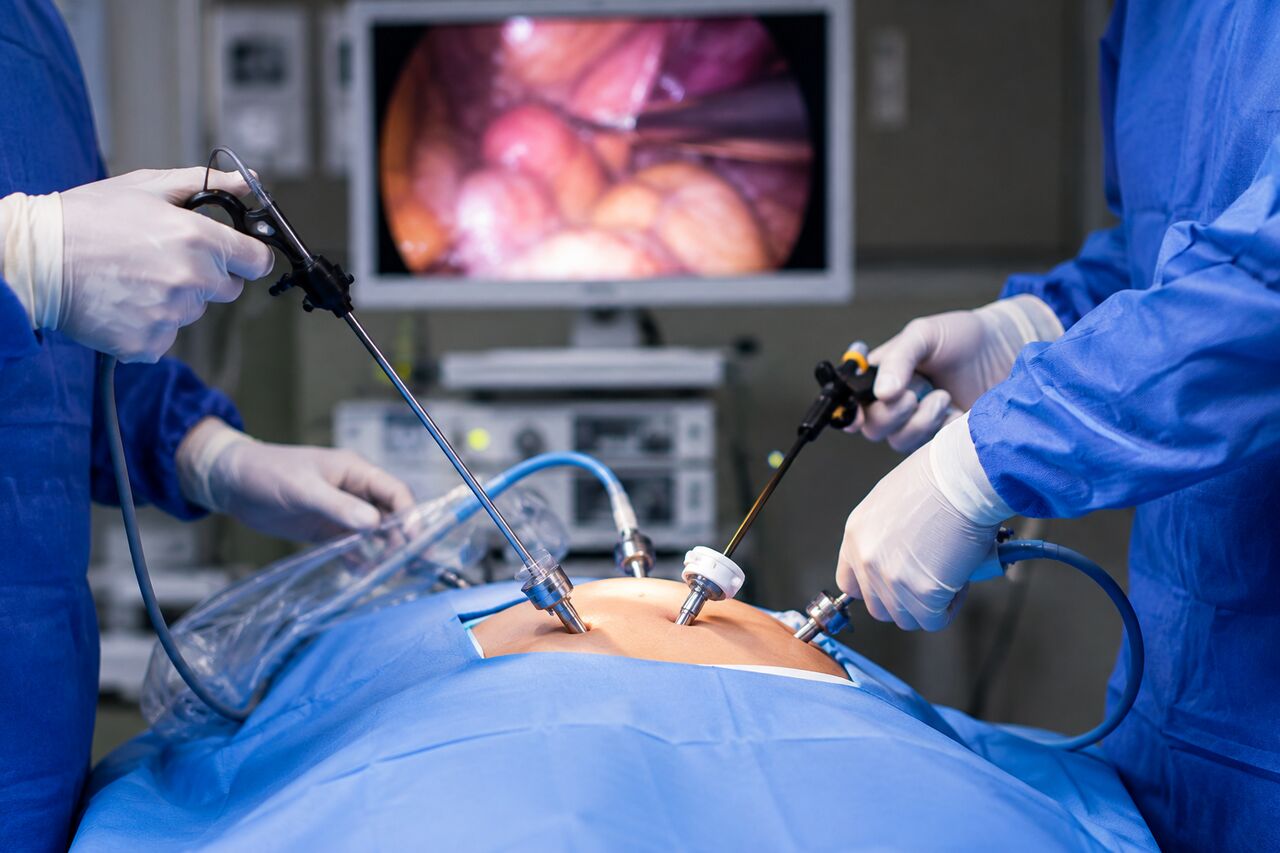 Lucknow, Health, Trusted Laparoscopic Surgery In Lucknow
