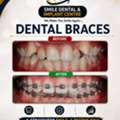 Get A Straighter Smile With Advanced Dental Braces!