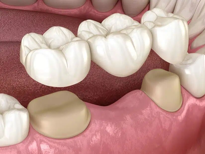 New York, Health, Close The Gap From A Missing Tooth With A Custom Dental Bridge