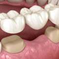 Close The Gap From A Missing Tooth With A Custom Dental Bridge