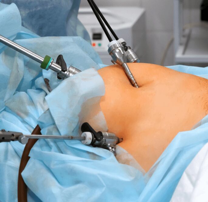 Mumbai, Health, Find Trusted Laparoscopic Doctor For Advanced Surgical Care