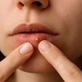 Bump On Lip: Common Causes, Signs & Treatment Options