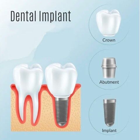 Sydney, Dental, Dental Implants Glenfield | Professional Implant Care