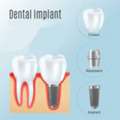 Dental Implants Glenfield | Professional Implant Care