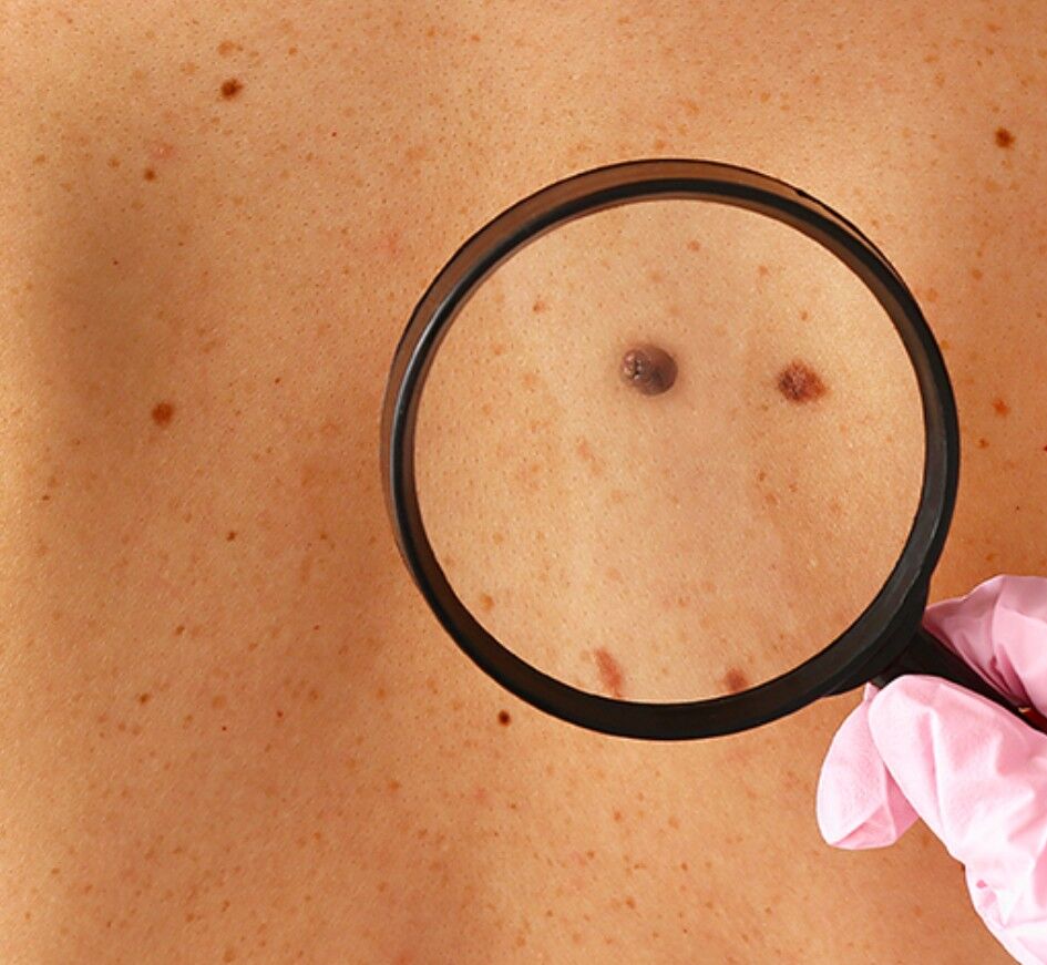 Sydney, Health, Skin Cancer Screening & Check