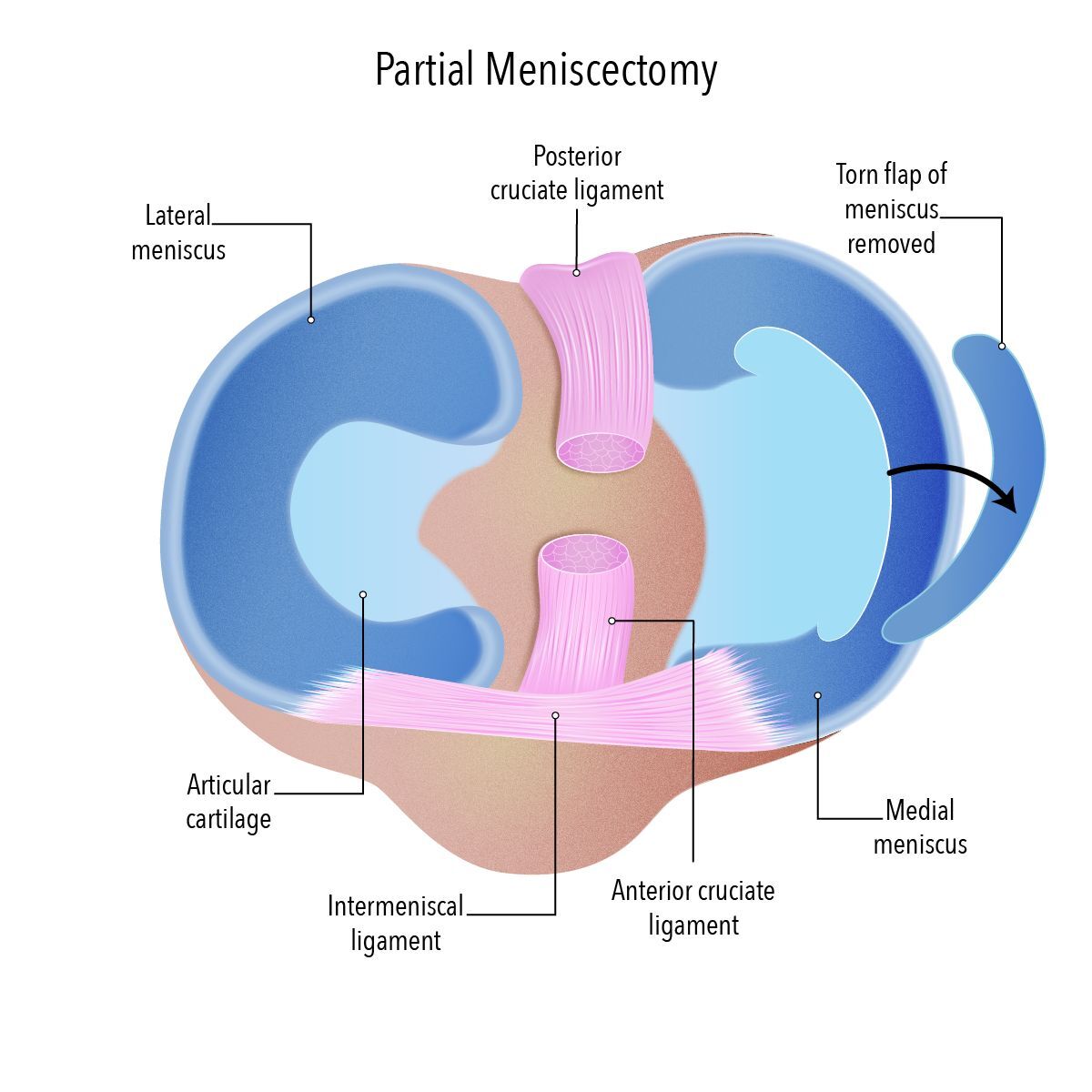 Melbourne, Health, Understanding Partial Meniscectomy For Meniscus Tears