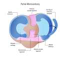 Understanding Partial Meniscectomy For Meniscus Tears