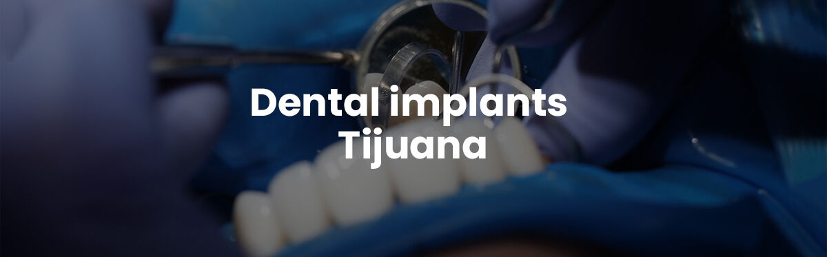 Mexico City, Dental, Dental Implants Tijuana Offers Natural-looking And Durable Teeth Replacements