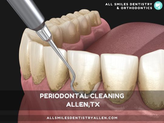 Dallas, Dental, Periodontal Cleaning Allen TX &ndash; Professional Gum Maintenance