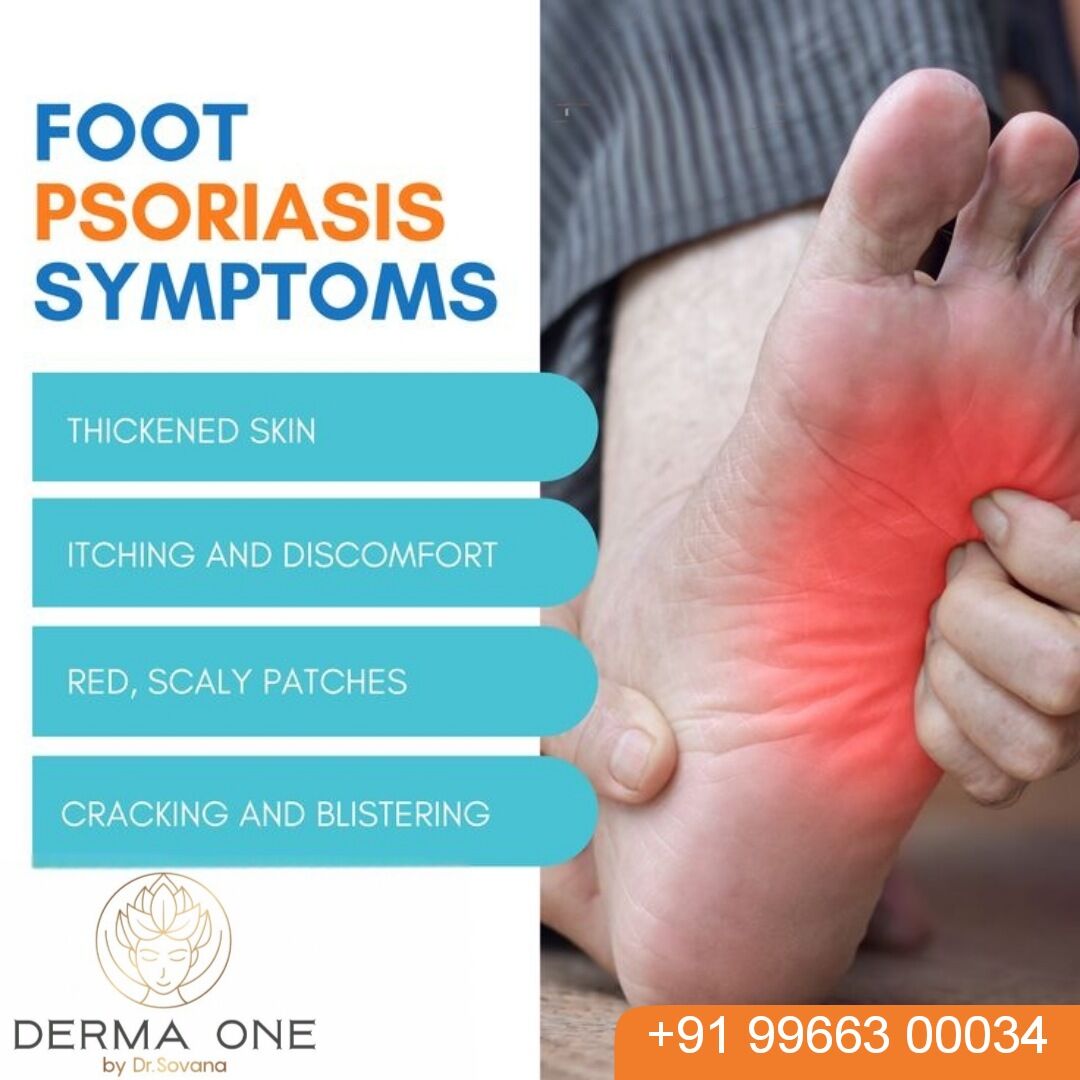 Visakhapatnam, Health, Signs Of Foot Psoriasis And Treatment- Dr Sushree Sovana