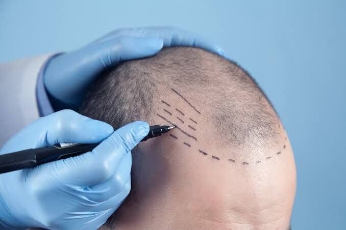 Bangkok, Health, Discover A Smarter Path To Hair Restoration