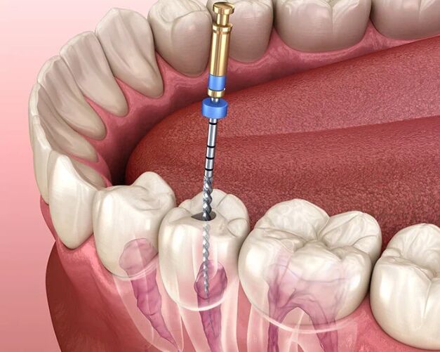 Ahmedabad, Dental, Reliable Root Canal Treatment For Damaged Teeth | The Dental Wellness Centre