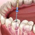 Reliable Root Canal Treatment For Damaged Teeth | The Dental Wellness Centre