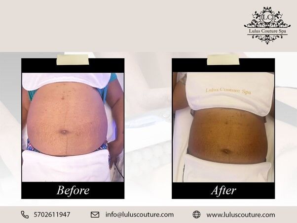 New York, Beautician, Top Body Sculpting Scranton PA For Targeted Contouring Results