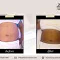 Top Body Sculpting Scranton PA For Targeted Contouring Results