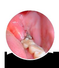 Melbourne, Health & Beauty Items, Best Wisdom Tooth Pain Extraction Services
