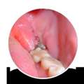 Best Wisdom Tooth Pain Extraction Services