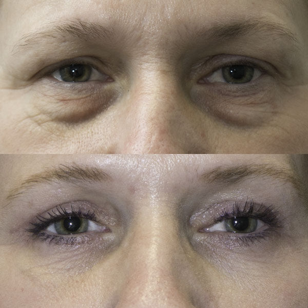 New York, Medical, Lower Blepharoplasty Technique: Understanding Modern Eyelid Rejuvenation Approaches