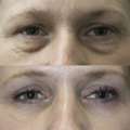 Lower Blepharoplasty Technique: Understanding Modern Eyelid Rejuvenation Approaches