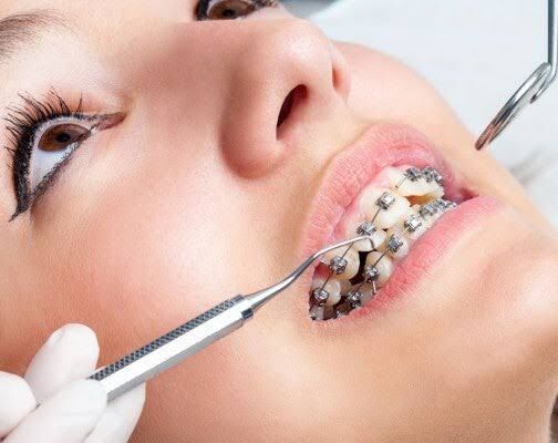Mumbai, Health, Braces Dentist Near Me For A Straighter And Healthier Smile