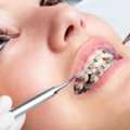 Braces Dentist Near Me For A Straighter And Healthier Smile