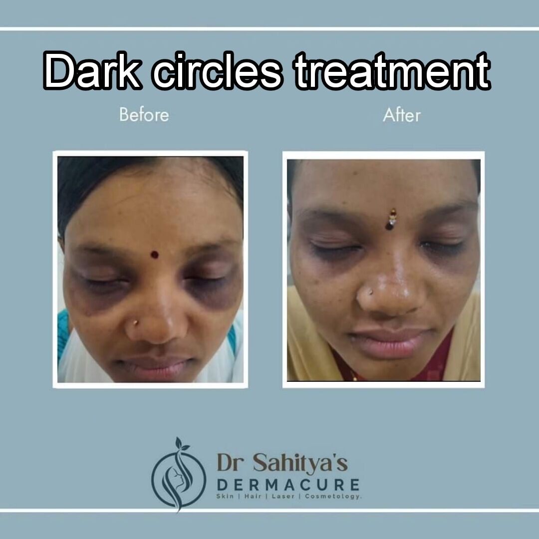 Kurnool, Health, Best Dark Circles Treatment At Dermacure By Dr Sahitya Reddy