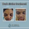 Best Dark Circles Treatment At Dermacure By Dr Sahitya Reddy
