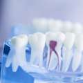How Root Canal Treatment Relieves Tooth Pain And Saves Teeth