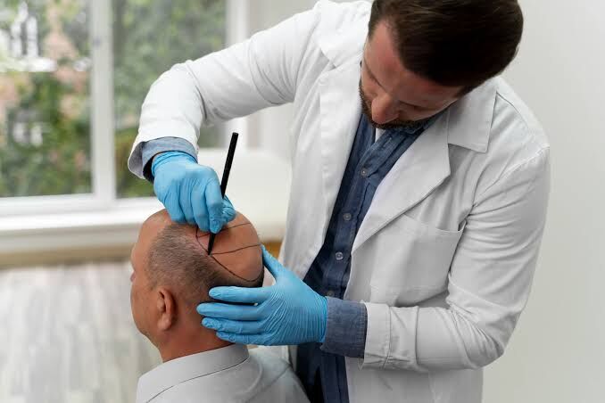 Chandigarh, Health, Advanced FUE Hair Transplant In Chandigarh For Fuller-Looking Hair
