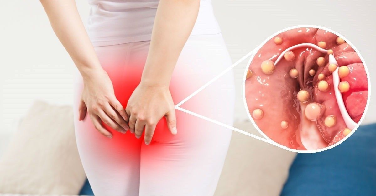 New Delhi, Health, Ayurvedic Care For Piles And Fistula With Expert Guidance