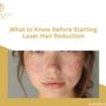 What To Know Before Starting Laser Hair Reduction