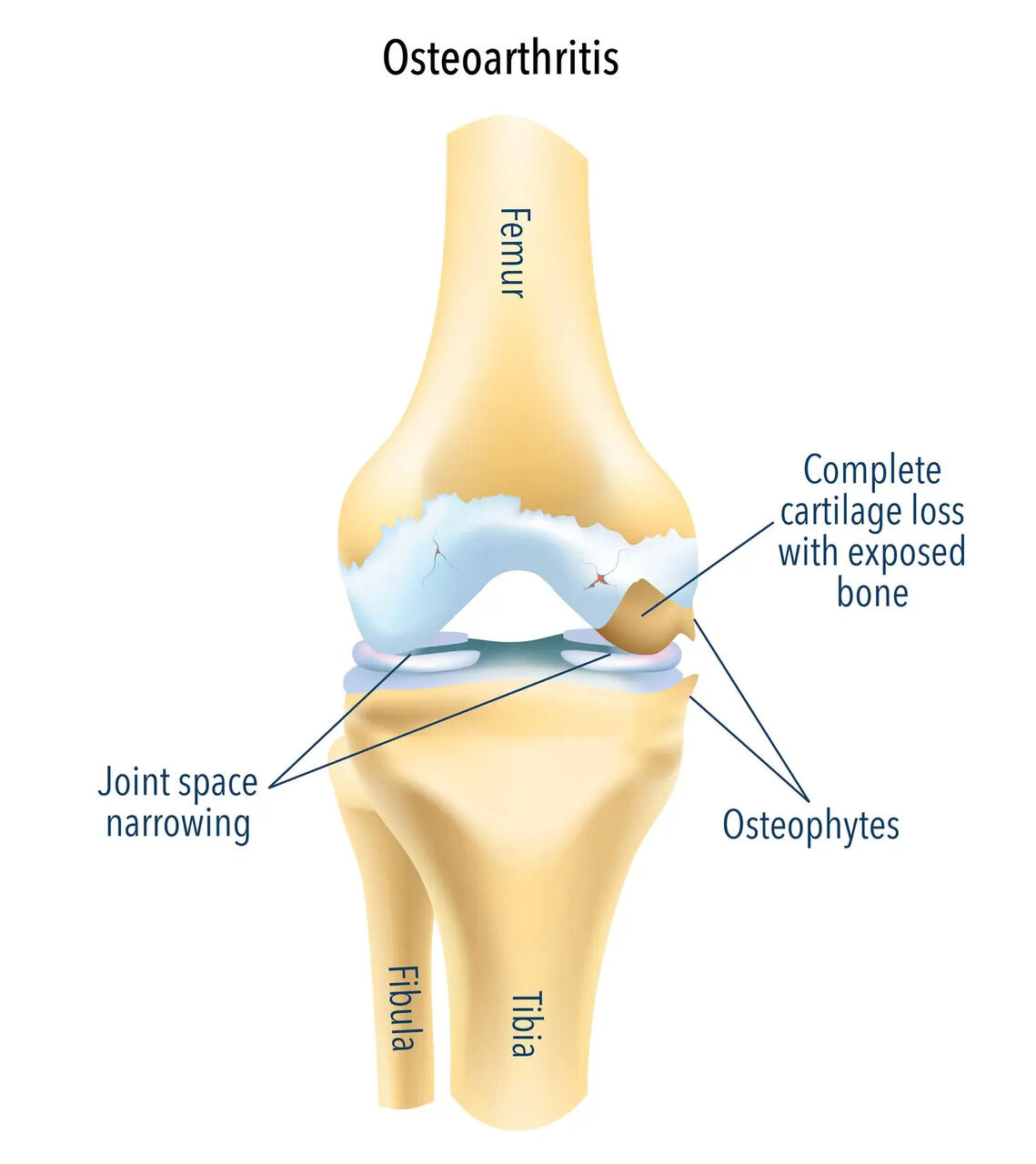 Melbourne, Health, Arthritis Knee Treatment Options Worth Understanding First