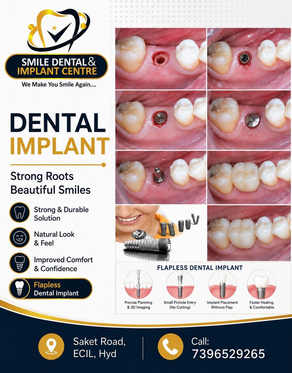 Hyderabad, Dental, Wondering About Dental Implant Costs? Get A Clear Answer.